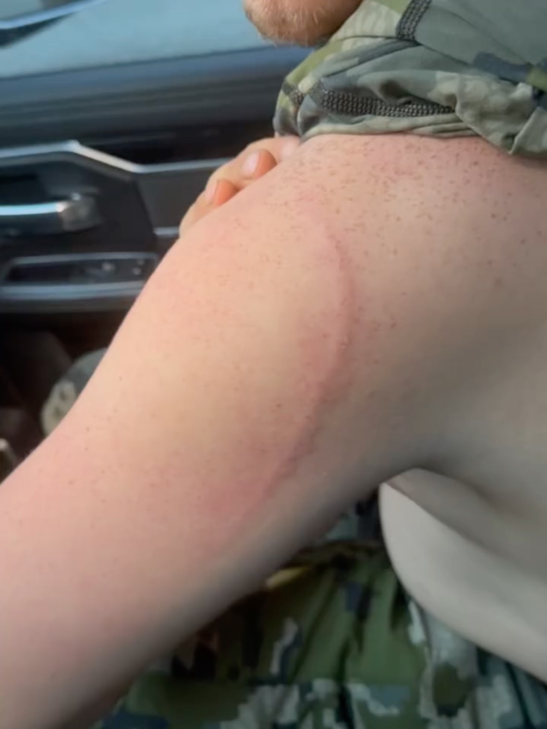 Trace in hand survives brown bear attack.